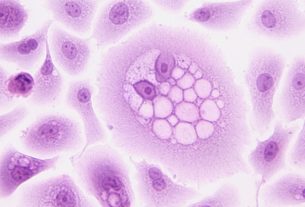 OMS Cancer Aumentara 2024