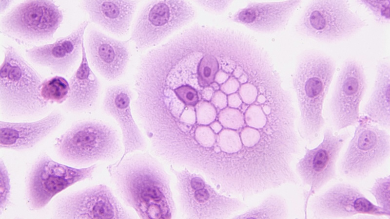 OMS Cancer Aumentara 2024